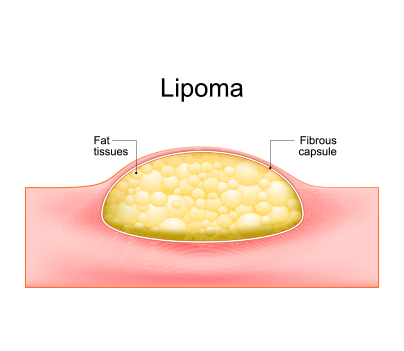 Lipoma Removal Surgery in Thane Lipoma Removal Surgery in Thane