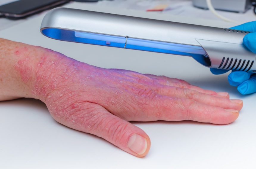 Best Phototherapy Treatment in Thane Best Phototherapy Treatment in Thane