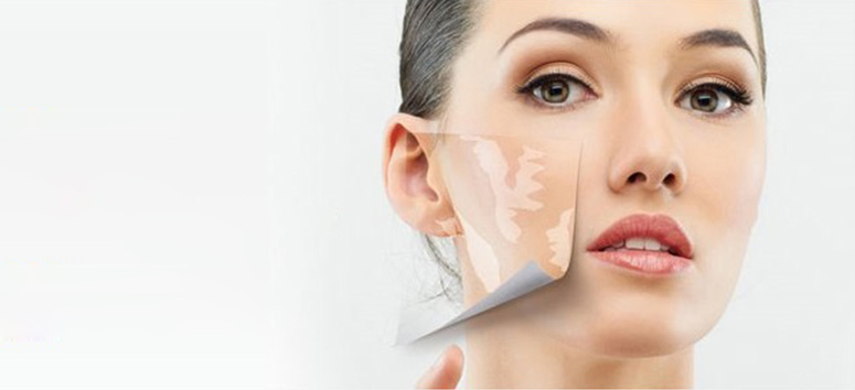 Vitiligo Treatment in Thane Vitiligo Treatment in Thane