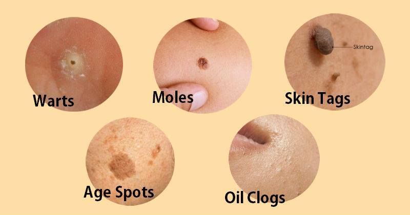 Wart Removal Treatment in Thane Wart Removal Treatment in Thane