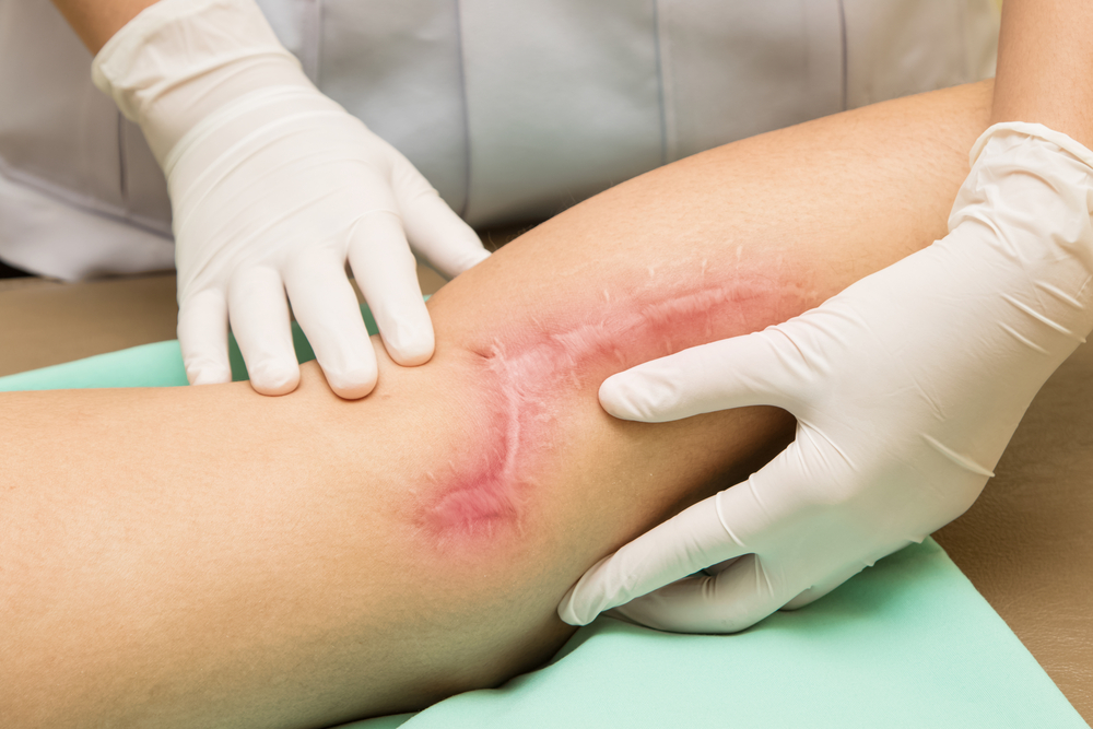 Scar Management surgery in thane Scar Management surgery in thane